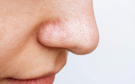 Duo Guide: Understanding Large Pores and How to Refine Them