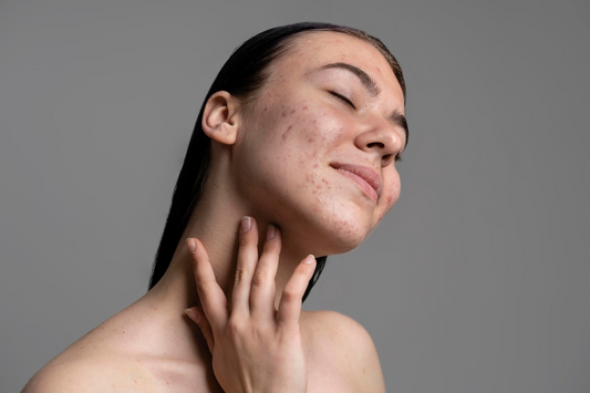 Duo Digest: Acne Scars – What Causes Them and How to Treat & Prevent Them