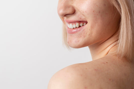 Duo Guide: Understanding Acne Stages