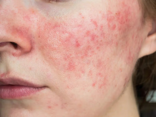 Duo Digest: How to Prevent and Treat Windburned Skin